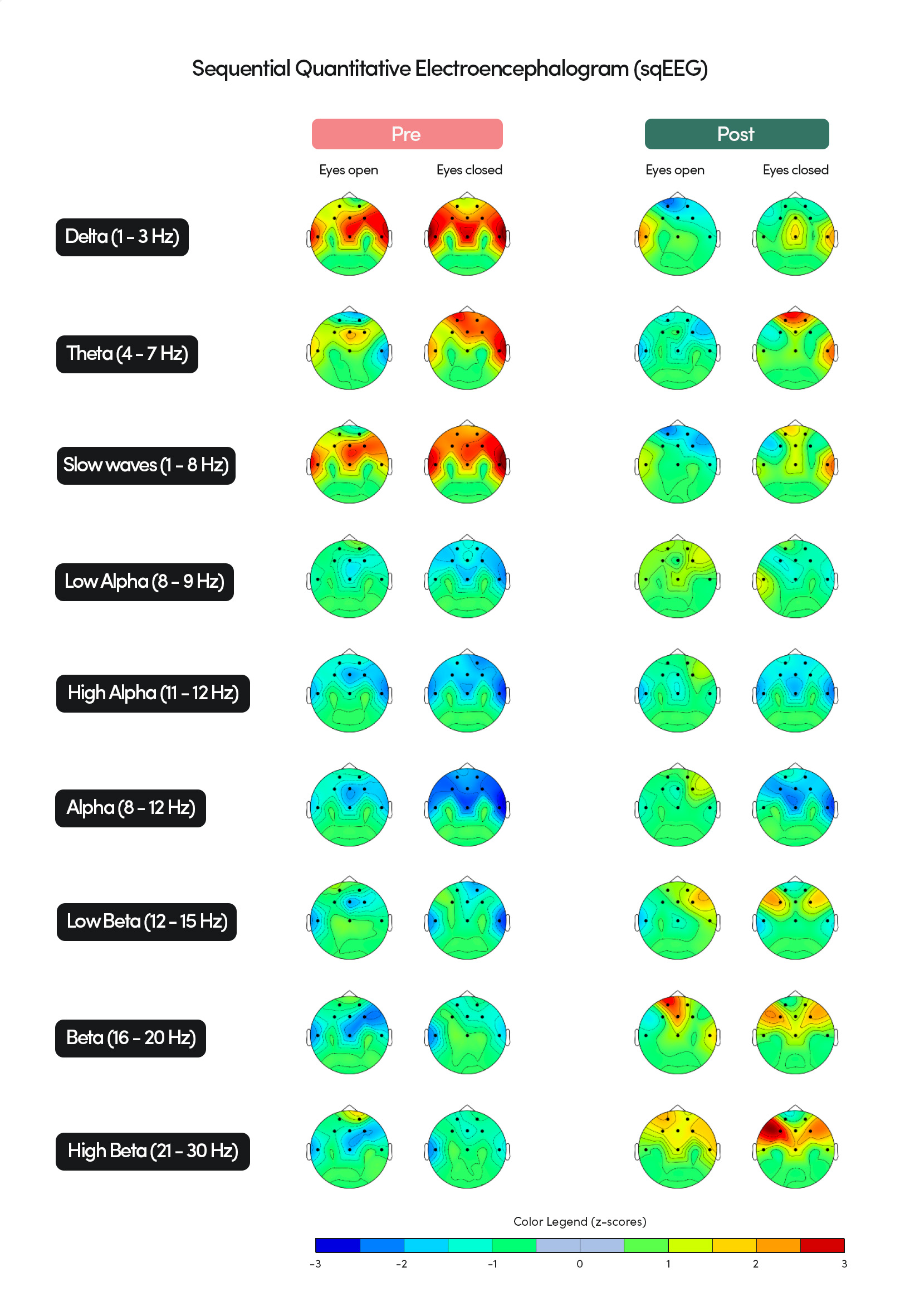 qEEG brain mapping visualization showing brainwave activity